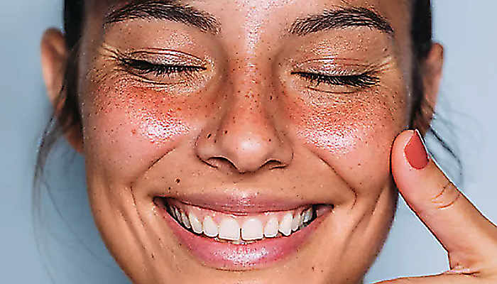 Rosacea: fenotypy, sp&uacute;&scaron;ťače a starostlivosť 
