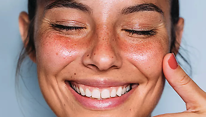 Rosacea: Starostlivosť o citliv&uacute;, začervenan&uacute; pleť